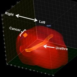 Precision Prostate patient A