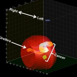 Precision Prostate patient B